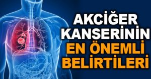 AKCİĞER KANSERİNİN EN ÖNEMLİ BELİRTİLERİ