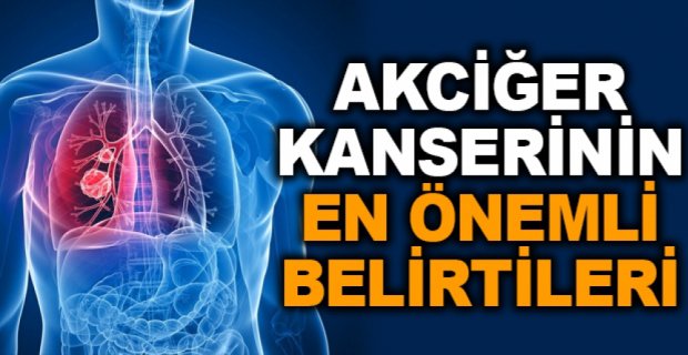 AKCİĞER KANSERİNİN EN ÖNEMLİ BELİRTİLERİ