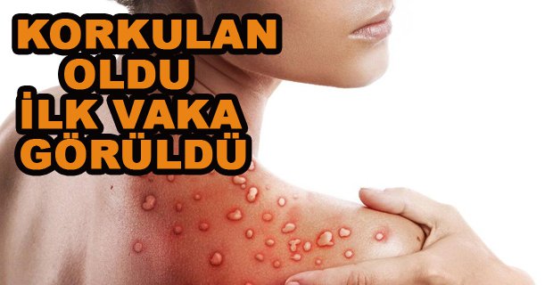 KORKULAN OLDU TÜRKİYE’YE SIÇRADI